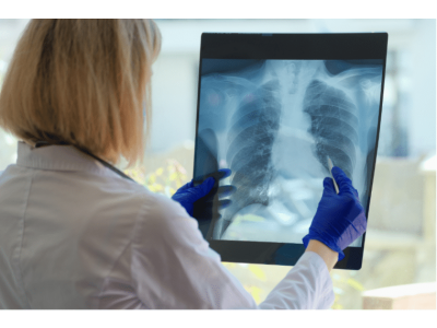 PLJUČNA FIBROZA: Od diagnoze do zdravljenja